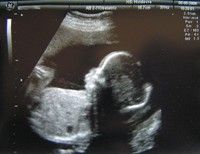 У Європі для зниження кількості абортів заборонять визначати стать дитини до народження